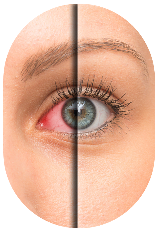 Comparaison entre un œil rouge et irrité et un œil à l’apparence normale